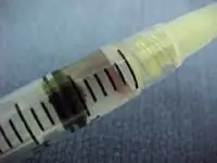 киста ганглия 2 киста ганглия 2