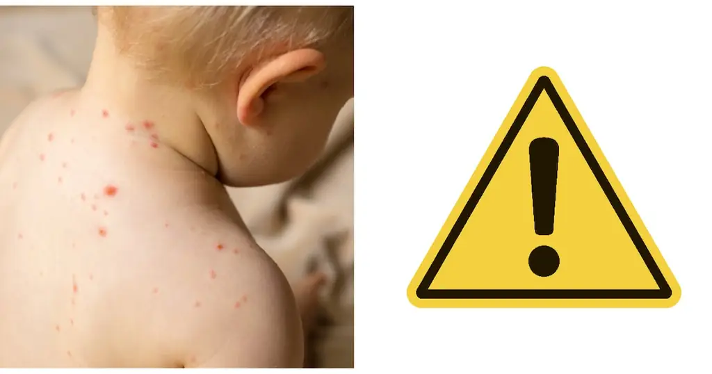 Ветряная оспа и скарлатина «коктейль» Предупреждение для родителей