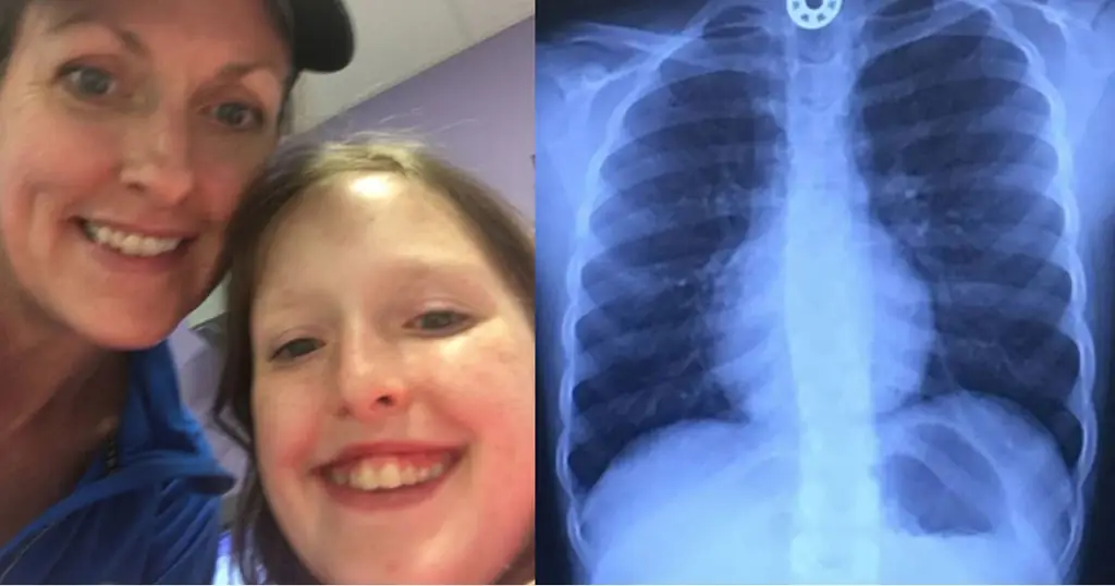 Предупреждение мамы после того, как дочь подавилась частью спиннера