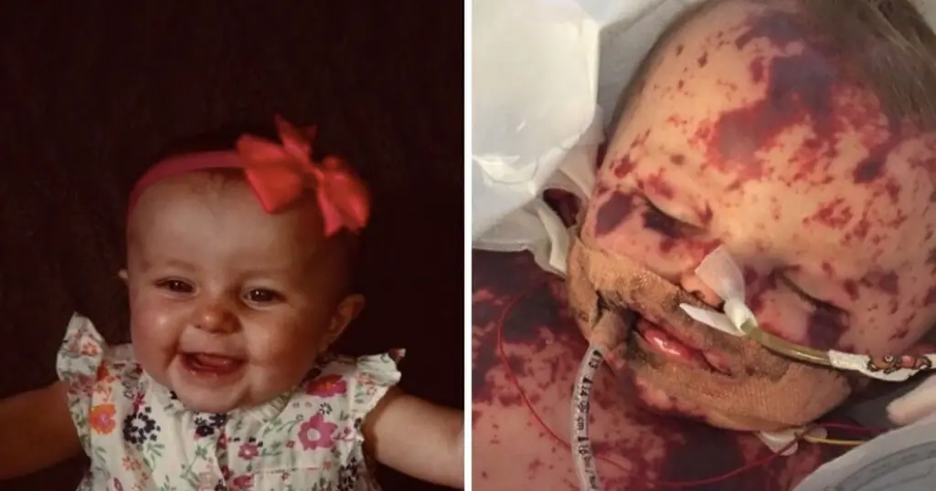 Ребенку с «худшим случаем менингита за последние десятилетия» ампутировали четвертую конечность