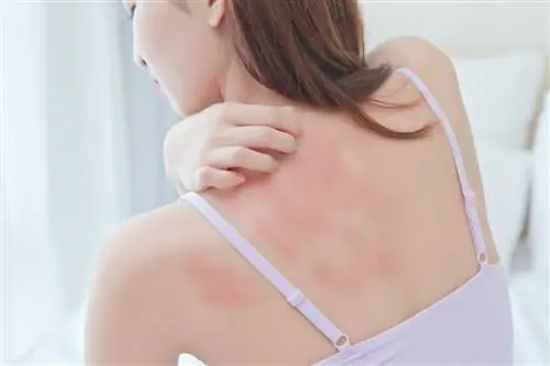 Как избавиться от крапивницы: местное лечение