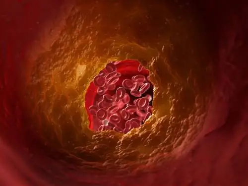 Почему тромбы чаще встречаются у людей с ВЗК