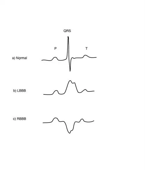 Что такое Bundle Branch Block?