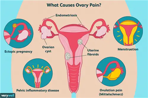 Причины болей в яичниках
