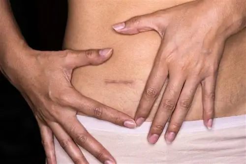 Что такое аппендэктомия?