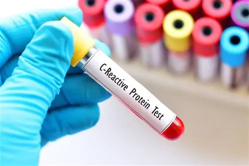 Что нужно знать о постановке диагноза дивертикулита