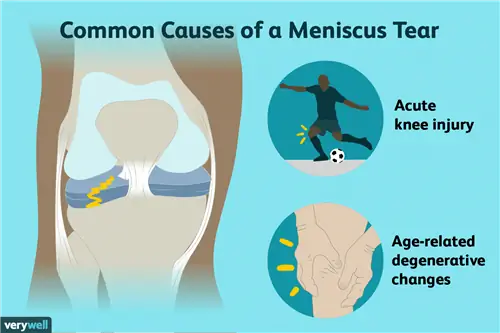 причины разрыва мениска