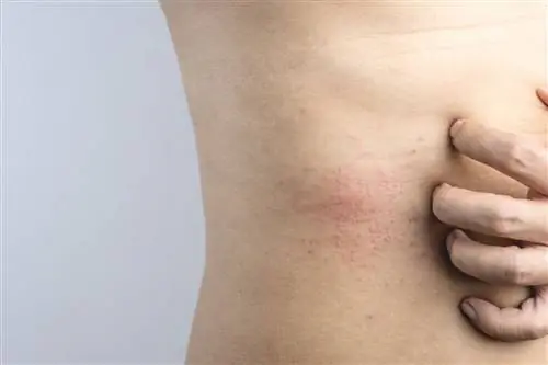 Рука мужчины царапает зуд на красной отметине чувствительной кожи как симптомы пищевой аллергии или аллергии на вредителей - стоковое фото