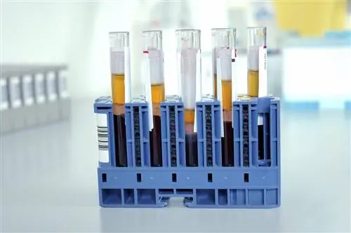 Симптомы высокого уровня гормона пролактина