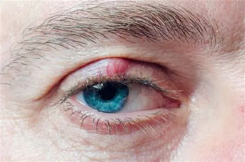 Хирургия халязиона: все, что вам нужно знать