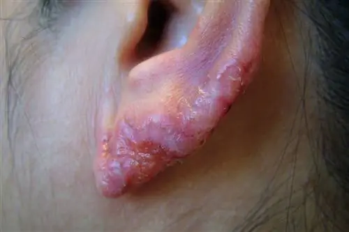 Человек с туберкулезом кожи на ухе (lupus vulgaris)