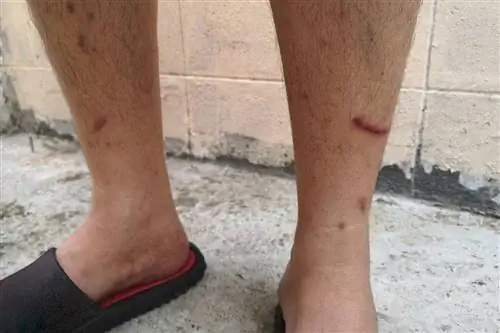 Диабетическая дермопатия: фото, симптомы, лечение