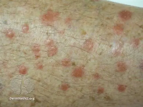 Что такое саркоидоз?