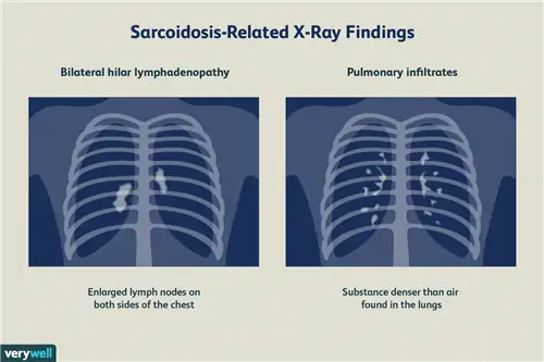 саркоидоз рентген