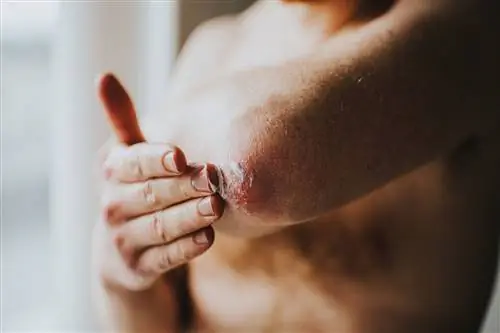 Что спросить у своего лечащего врача, прежде чем сменить лекарство от псориаза