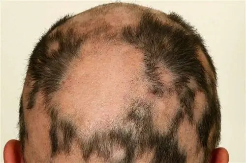 Алопеция на голове человека