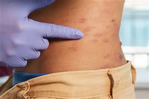 Рука в перчатке указывает на кожу с сыпью опоясывающего герпеса (опоясывающего лишая)