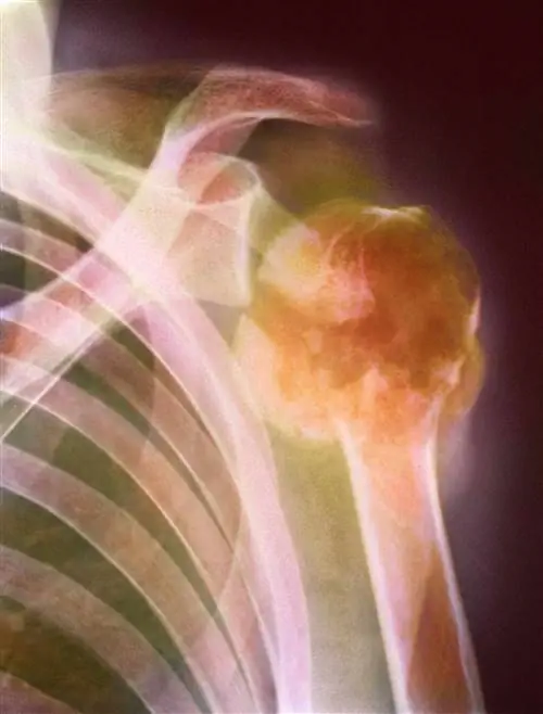 Что такое множественная миелома?