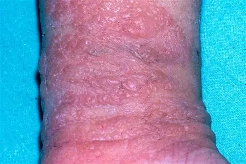 Человек с аллергическим контактным дерматитом (экземой) на руке
