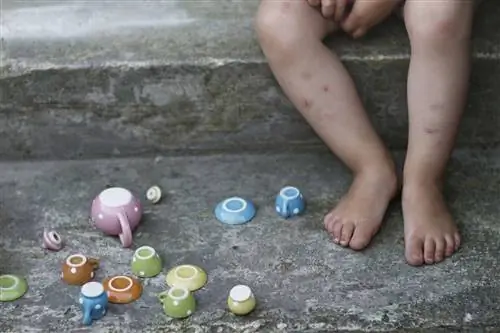 Ноги ребенка с синяками и укусами насекомых