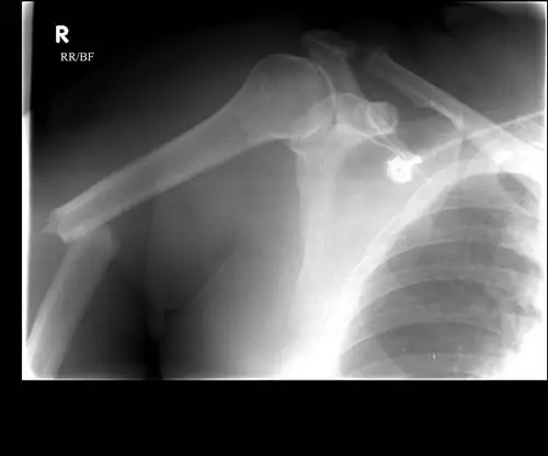 Переломы проксимального, среднего и дистального отделов плечевой кости