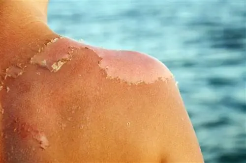 Шелушение загорелой спины
