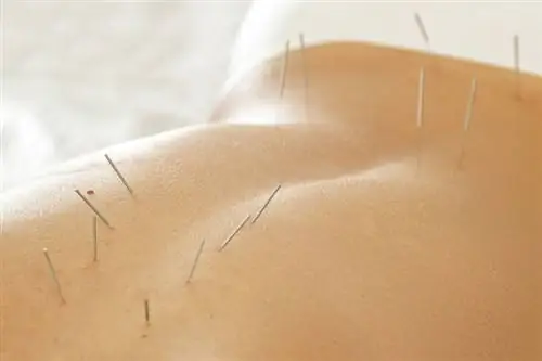 Иглы для иглоукалывания в спине женщины