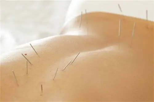 Иглоукалывание для больных раком