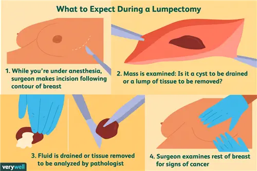 чего ожидать во время лампэктомии