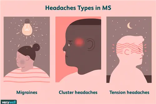 Типы головной боли при рассеянном склерозе