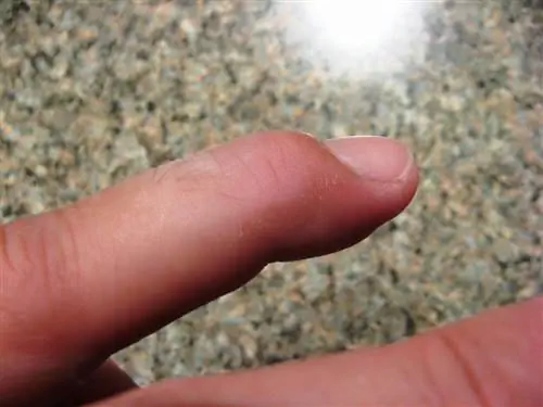 Растянутые сухожилия и сломанные кости постоянно держат молоткообразные пальцы согнутыми