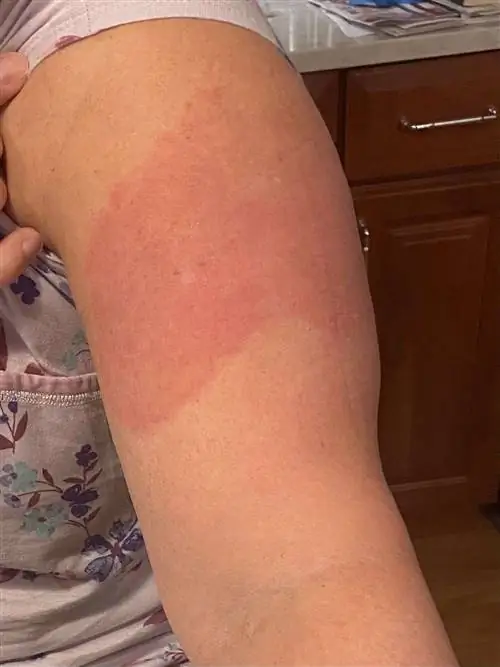 Фото сыпи на руке.