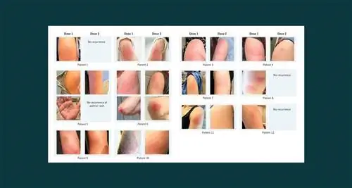 Если у вас есть кожная реакция на вакцину Moderna COVID-19, не паникуйте