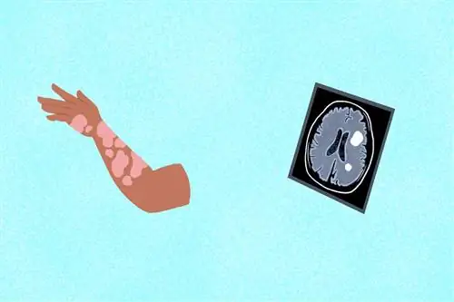 Псориатический артрит и рассеянный склероз: в чем разница?