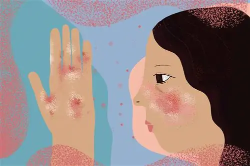 Псориатический артрит и волчанка: в чем разница?