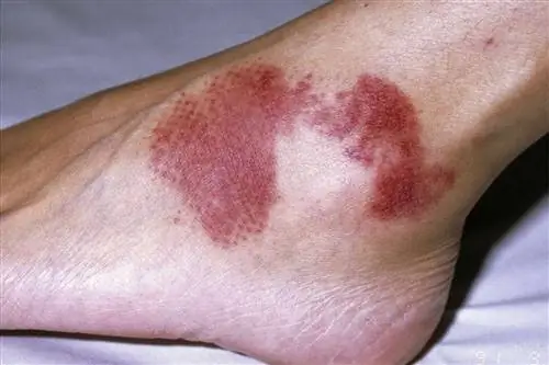 Пурпура на лодыжках и стопах