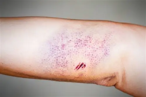 Петехии против пурпуры: что изменение цвета кожи может рассказать о вашем здоровье