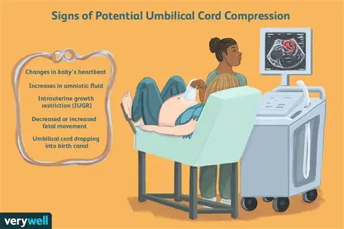 Признаки потенциальной компрессии пуповины