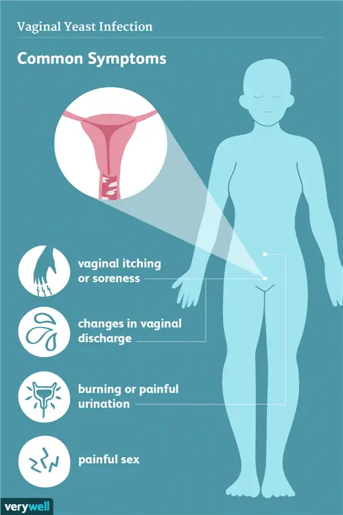 симптомы молочницы влагалища