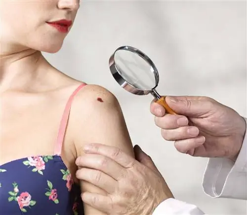 Меланома 4 стадии