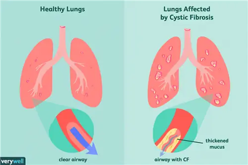 Понимание кистозного фиброза