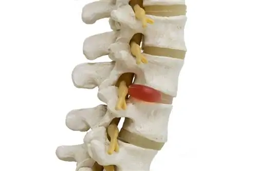 Модель с грыжей диска