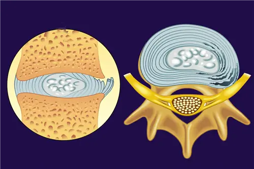 Три причины, по которым ваши спинные диски могут вызывать боль в спине