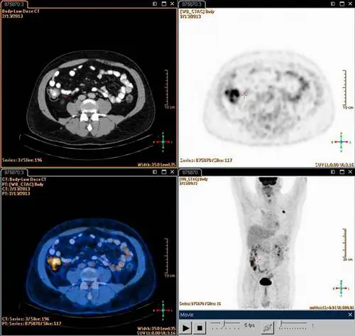 Лимфома Ходжкина и роль ПЭТ/КТ
