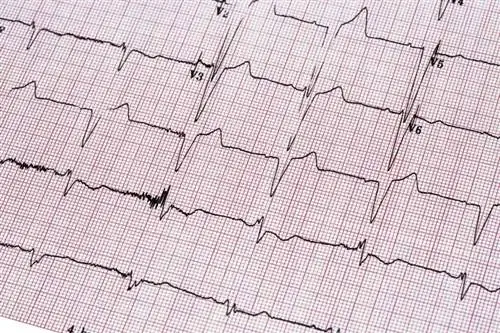 эхокардиограмма