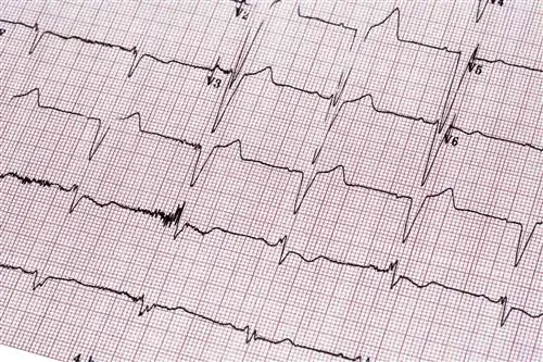 Ранняя терапия с контролем ритма может улучшить результаты лечения мерцательной аритмии, показывают результаты исследования