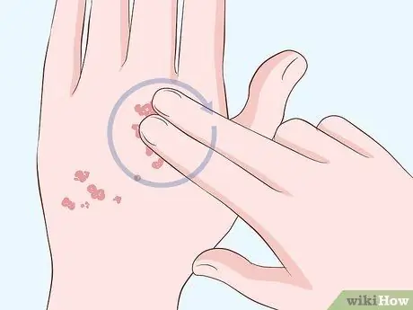 Лечение шрамов от чесотки, шаг 1