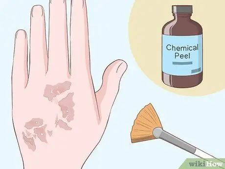 Лечение шрамов от чесотки, шаг 9