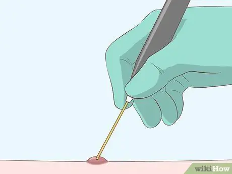 Лечение шрамов от чесотки, шаг 10