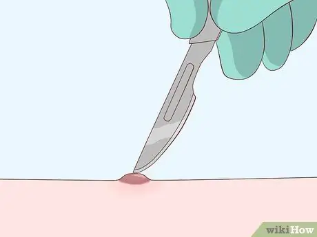 Лечение шрамов от чесотки, шаг 11